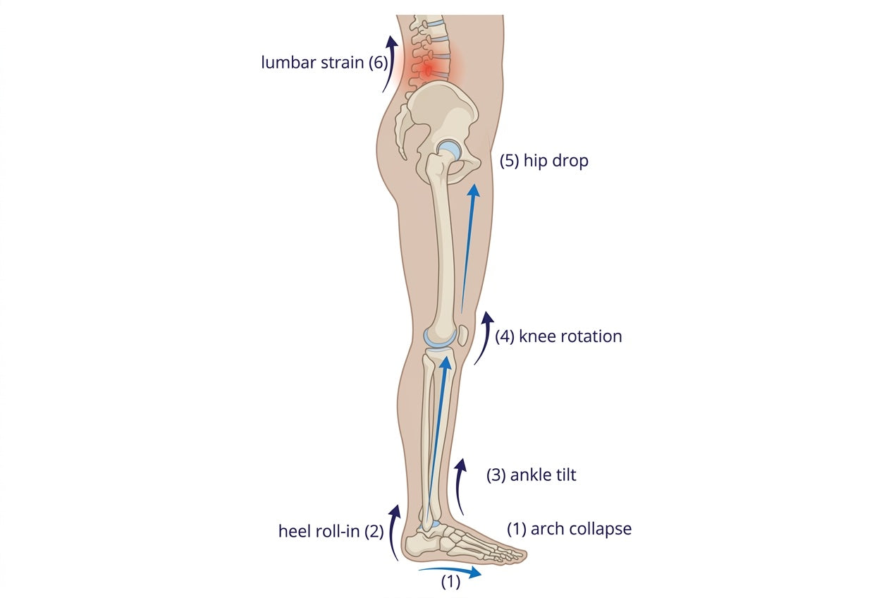 Anatomical kinetic-chain diagram: arch collapse causing heel inversion, ankle tilt, knee medial rotation, hip drop, and uneven lumbar compression.