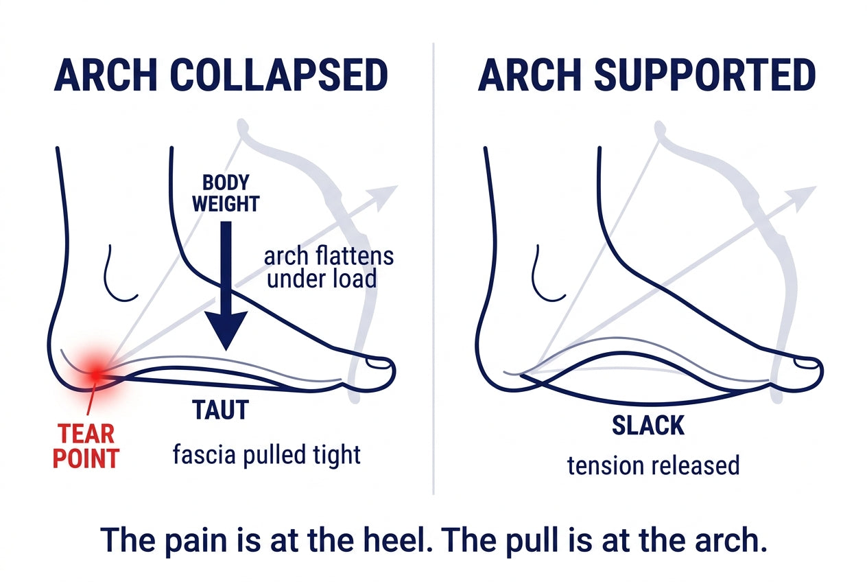 Bowstring diagram: a collapsed arch pulls the plantar fascia taut and tears it at the heel anchor; a supported arch lets the fascia go slack and releases the tension.